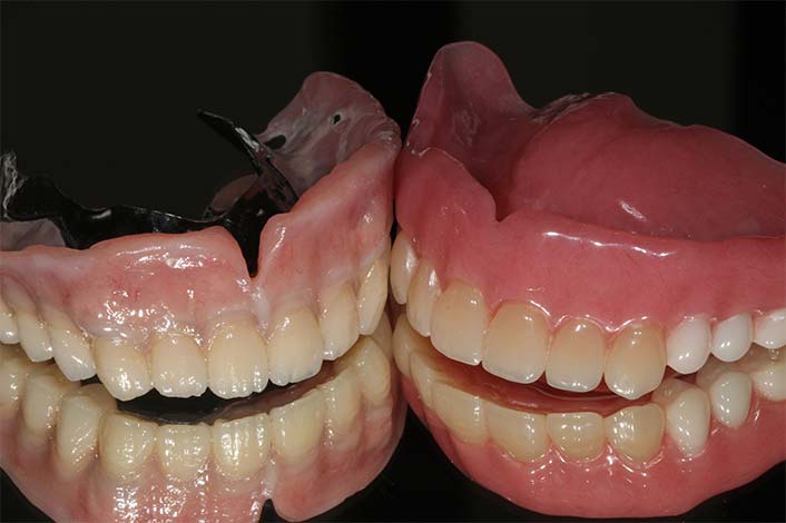 保険の入れ歯との比較（右：保険の入れ歯）