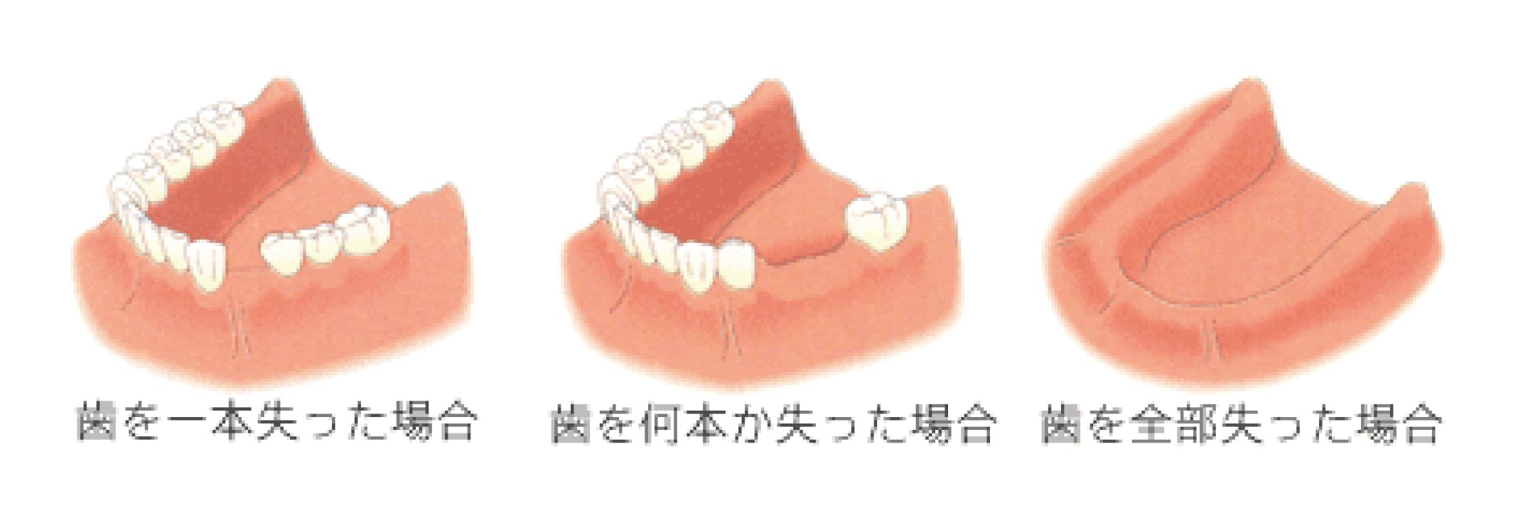 失われた歯のイメージ